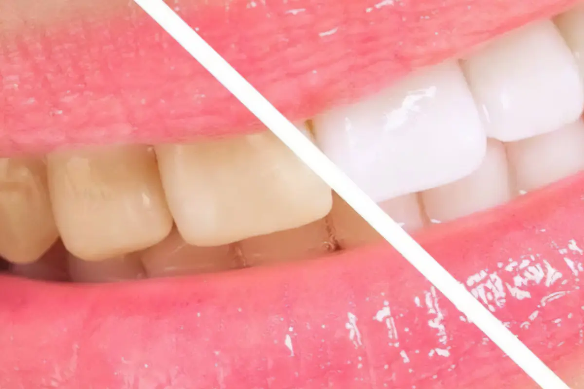 Sbiancamento dei denti: controindicazioni